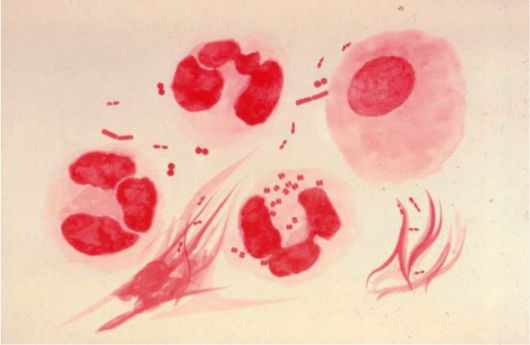 Rycina 1 - normalna flora pochwy - widoczne są pałeczki z rodzaju Lactobacillus